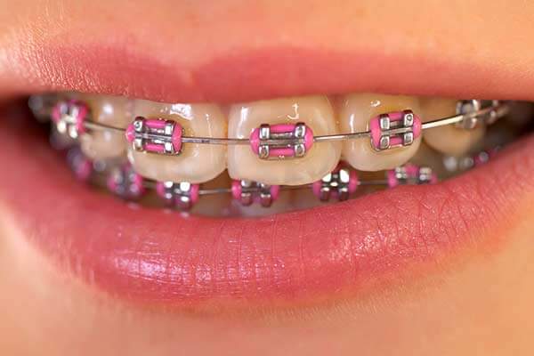 Metal-Braces