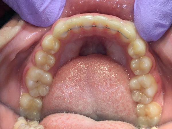 Orthodontic-Retainer