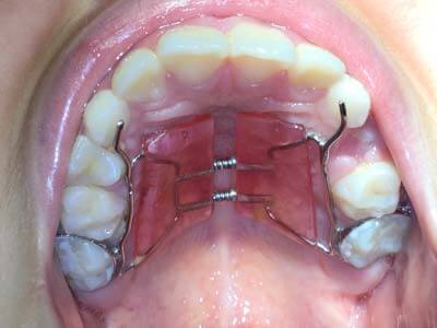 palatal-expander